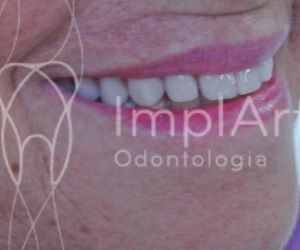 carga_imediata_implante_total_48kb Novo Implante Straumann iEXCEL: implante rápido com osseointegração em 21 dias