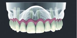 all-on-six-seis-implantes-dentarios Por que trocar sua prótese fixa sobre dentes por implante com coroa?