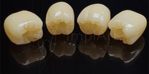 coroas_zirconia_zolid_50kb Gengiva inchada: o que pode ser?