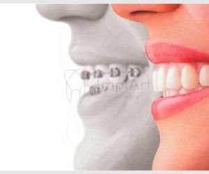 Alinhadores_transparentes_19kb All on 4 Implants in Brazil: affordable Smiles