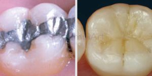restauracao_metalica_resina_50kb Perda óssea nos dentes: O que é | Porque acontece| Tratamento