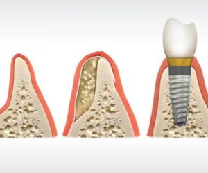 defeito_osseo_enxerto_implante_50kb Dentaduras modernas: cuidados e novas técnicas