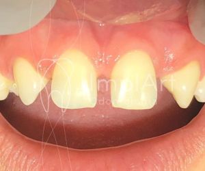 agenesia_50kb Coroa dentária em um dia para restaurar dentes rápido