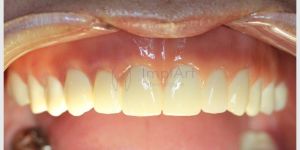 protese_total_zirconia_45kb Qual a diferença entre pivô, coroa e jaqueta?