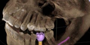 tomografia_radiologia_digital_50kb Maneiras simples de clareamento natural dos dentes funcionam?