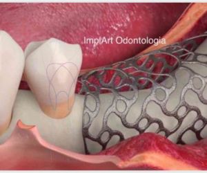 tela_titanio_para_enxerto_40kb ImplArt - Spa odontológico - Clínica de implantes dentários e estética dental