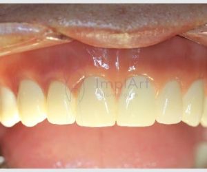 protese_total_zirconia_45kb Epilepsia e a Odontologia: tratamento dental e implante dentário