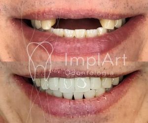 Implante_dentario_de_4_dentes_na_frente_50kb Sedação odontológica: tratamento dentário para odontofobia