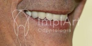 protese_protocolo_branemark_sobre_implantes_50kb O que é zircônia dental? E porque é o melhor material ?