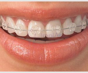 aparelho_ortodontico_est%C3%A9tico_49kb ImplArt - Spa odontológico - Clínica de implantes dentários e estética dental