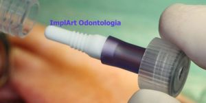 implante-de-zirconia-ceramica-straumann-2 Núcleo estético de fibra evita o uso de metal