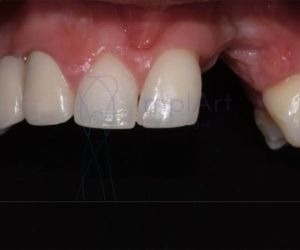 perda_ossea_reabsorcao_50kb Cirurgia de implante guiada (fechada) ou cirurgia aberta