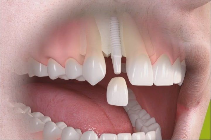 implante_straumann_pure_ceramic_49kb Implante dentário: a idade do paciente interfere no sucesso?