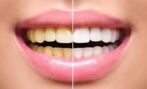 clareamento-dental Maneiras simples de clareamento natural dos dentes funcionam?