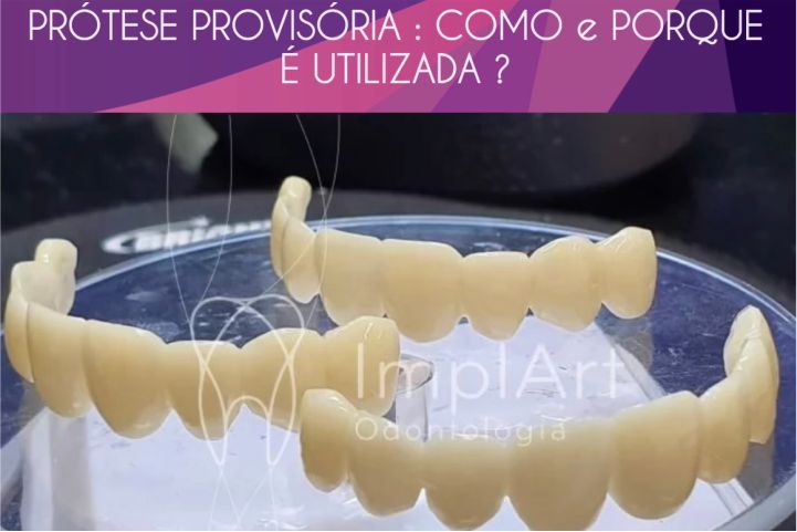 PROTESES-PROVISORIAS-COMO-E-PORQUE-E-UTIIZADA Implante dental: prótese provisória ajuda na estética final