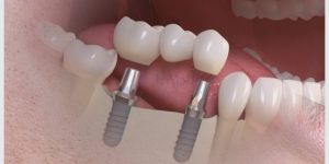 ponte_sobre_implantes_43kb Retração gengival é reversível?