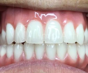 protese_metaloplastica_resina_50kb Especialista em implantes dentarios - Implantodontista Dr. Roberto Markarian