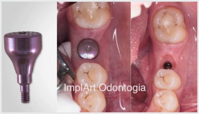 implante_caiu_40kb Meu implante dentário caiu!