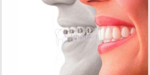 Alinhadores_transparentes_19kb Fumar pode prejudicar os implantes dentários