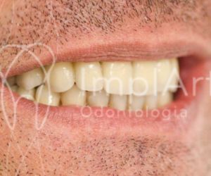 carga_imediata_implante_total_49kb Implante dentário em quem usa aparelho ortodôntico