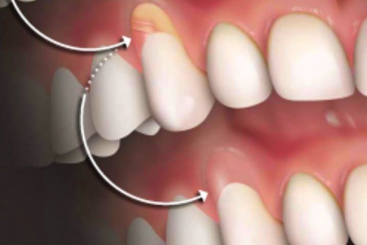 enxerto_de_gengiva_50kb Por que o enxerto gengival é considerado difícil?