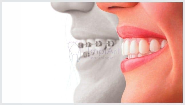 Alinhadores_transparentes_19kb Aparelhos ortodônticos modernos e convencionais