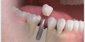 implante dentario unitario individual