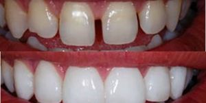 admin ajax.php?action=kernel&p=image&src=%7B%22file%22%3A%22wp content%2Fuploads%2F2022%2F11%2Flente contato dental diastema 50kb