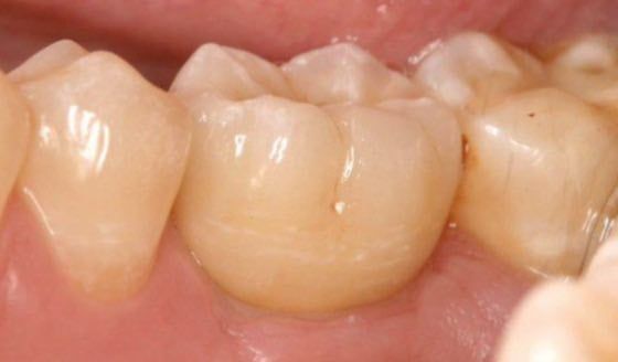 implantes nos dentes do fundo 4 vista lateral