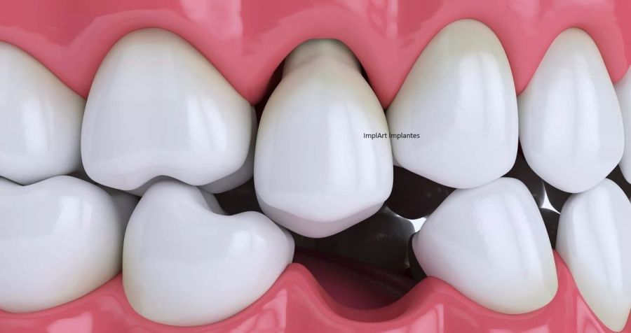 dente mole dentes moles o que causa