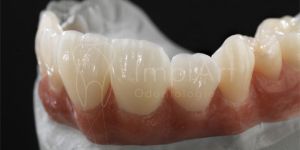 coroa zirconia multilayer 50kb 0b906ff2