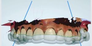 cirurgia guiada de implantes 40kb 0f015f40