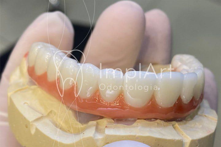 protese total zirconia superior para implantes 50kb 0f26df49