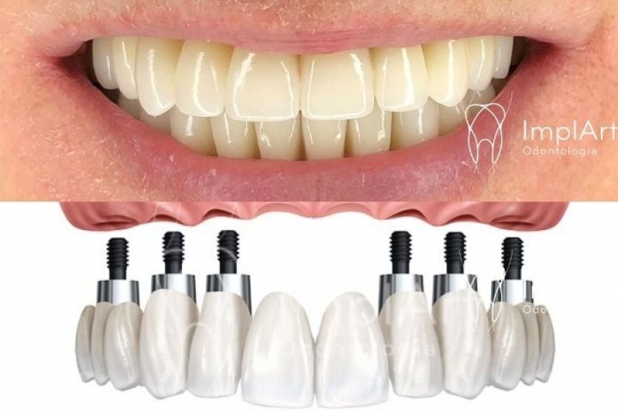 Implantes All on 6: Solução Completa para o Sorriso com implantes 1 all on 6