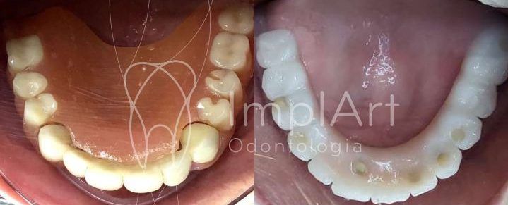 implante protese zirconia total antes e depois 48kb e1683839971145 1e9c73d5