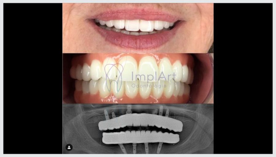 protese total zirconia translucida monolitica 40kb 1ff5a9b3