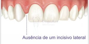 agenesia dental 2300a097