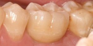 implantes nos dentes do fundo 4 vista lateral