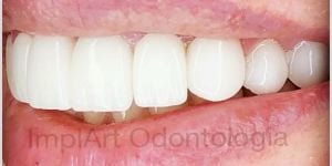 coroas de porcelana lente de contato dental 40kb 34adfbd2