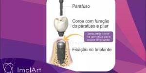 reabertura-de-implante-720-x-480-px-2-3c50560f Tratamento estético dental rápido com dayclinic