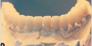 Reabilita%C3%A7%C3%A3o oral com coroas de porcelana 30kb 3db7cebf