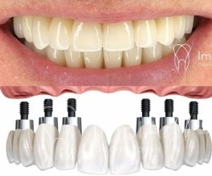 all-on-6-40a2f617 Vídeo: cirurgia de implante dentário