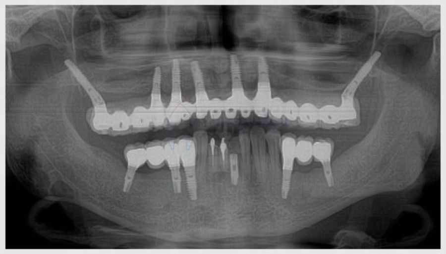 implante zigomatico 45kb 459c308d