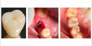 Coroa de zirconia translucida para implantes 40kb 462f458c