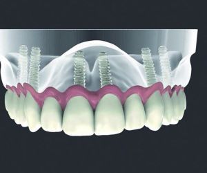 all on six seis implantes dentários