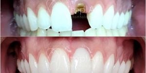 implante unitario coroa metal free antes e depois 50kb 6d515da4