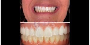Reabilitacao oral total superior e inferior em zirconia translucida 40kb 72ed5ee2