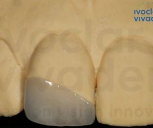 fragmento ceramico lente dental 50kb 85a1159c