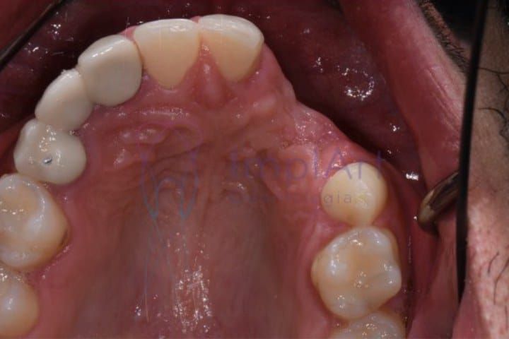 perda ossea falta dentes 50kb 8fe49f14