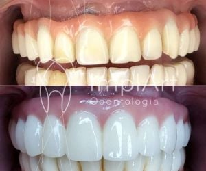 protese total fixa em zirconia implante antes e depois 50kb 8f69e05c